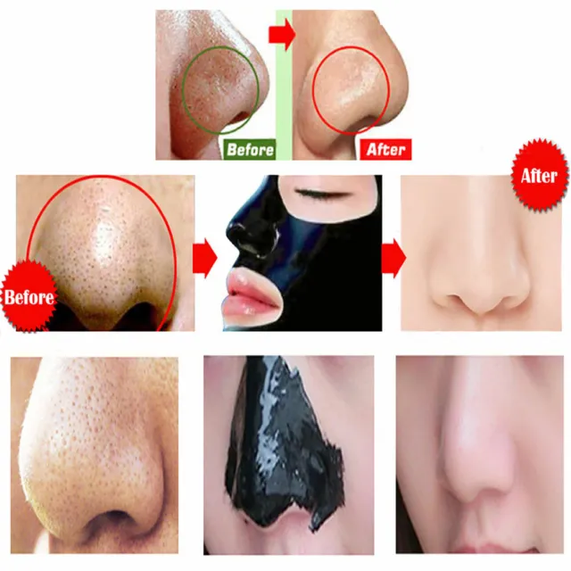 Máscara facial negra purificadora de espinillas eliminación de poros pelar cabezal 3