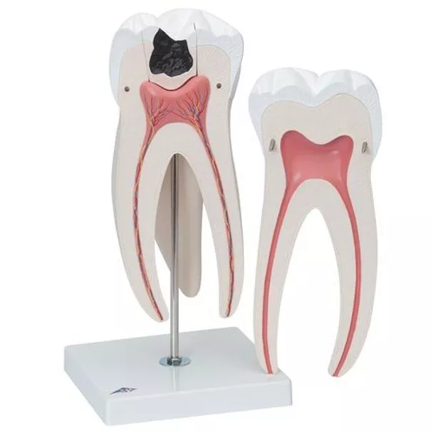 3B Scientific D15 Giant Molar w/ Dental Cavities Model, 15x Life-Size *NEW*
