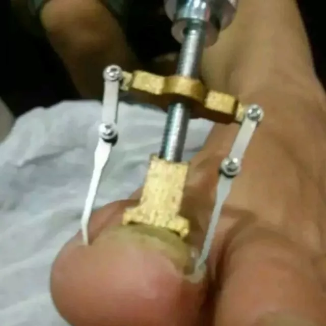 Professional Ingrown Toe Nail Correction Kit Pedicure  Treatment Tools Set N*xd