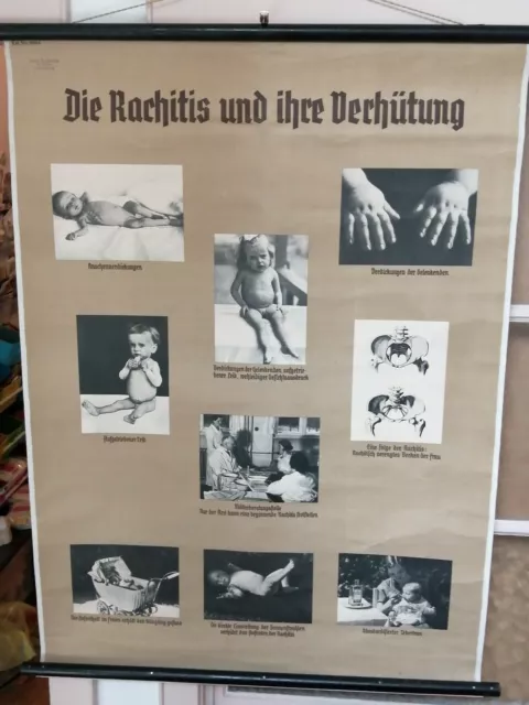 Alte Rollkarte Schulwandkarte Lehrtafel Wandbild:Rachitis und ihre Verhütung