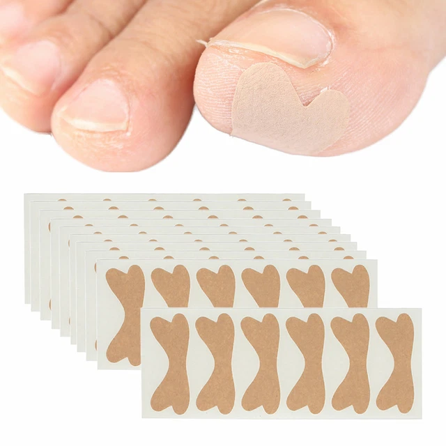 Patch de Correction Ongles Incarné, Autocollants de Soins de Pied Pédicure