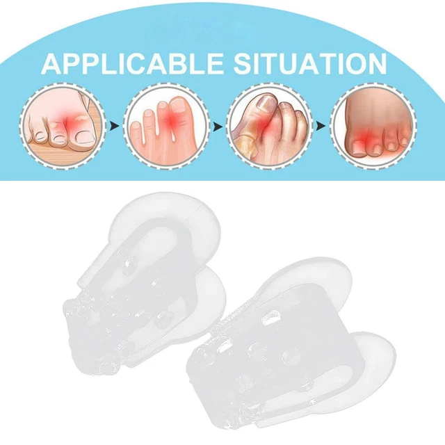 2X SOFT TOE Separators Spacers Dividers Big Toe Alignment Prevent