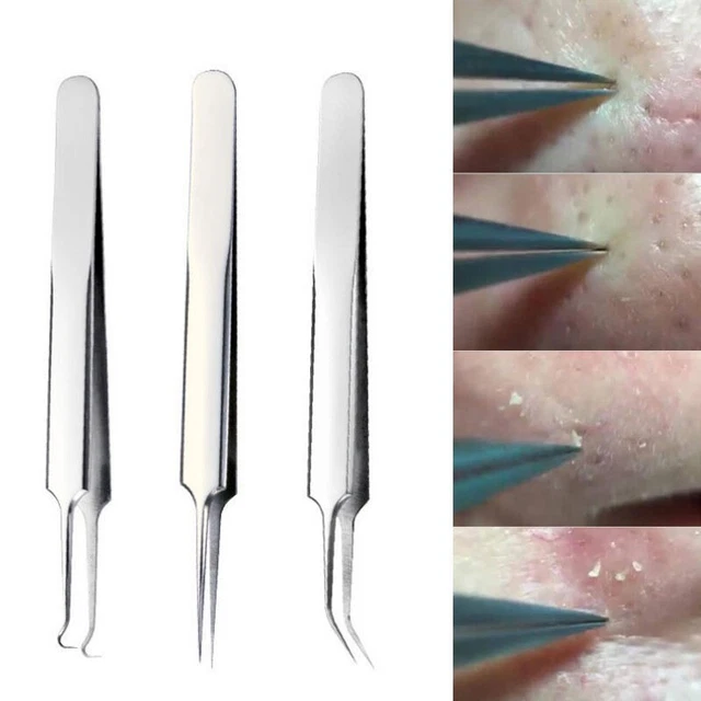 Removedor de acné con clip doblado pinzas espinillas herramienta de plata kit conjunto espinillas