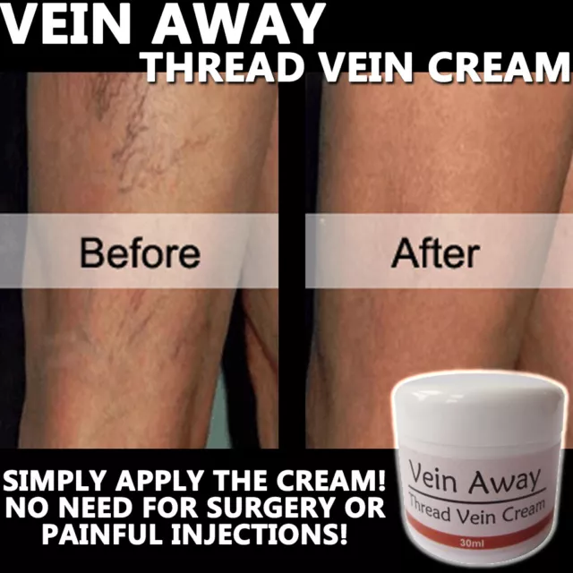 VEIN AWAY CREME Entfernen Sie hässliche Spinnen-/Fadenvenen! Schmerzfrei und schnell! 2