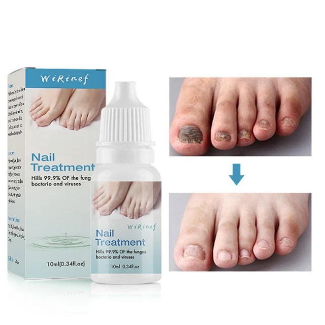 Fungus Treatment Essence Repair Foot Toe Fungal Removal Gel Anti Infection Y6T0