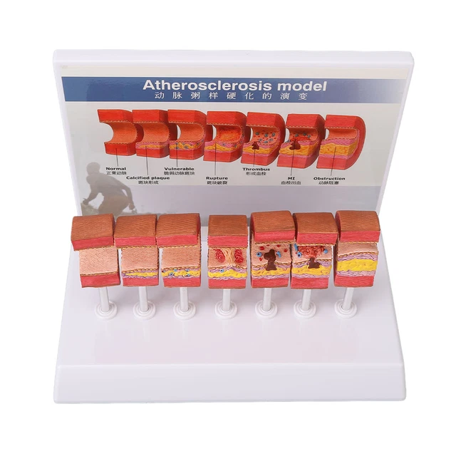 PVC Medical Model of Human Arterial Atherosclerosis with Thrombus Vascular Arteriosclerosis Educational Simulation Tool