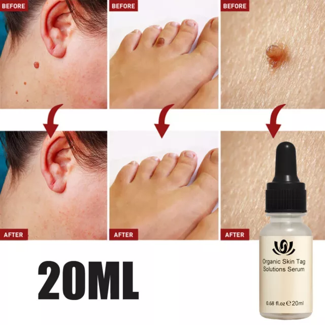 Wart Remover Pen Skin Tag Mole Remover Eliminate Foot Corn Warts Unisex  Organic Tags Solutions Serum New