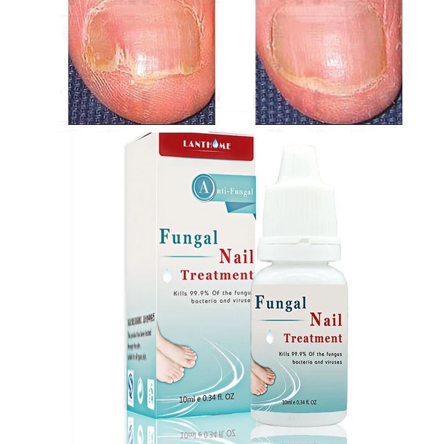 LANTHOME FUNGAL LIQUID Nail Treatment Nail And Foot Whitening Toenail