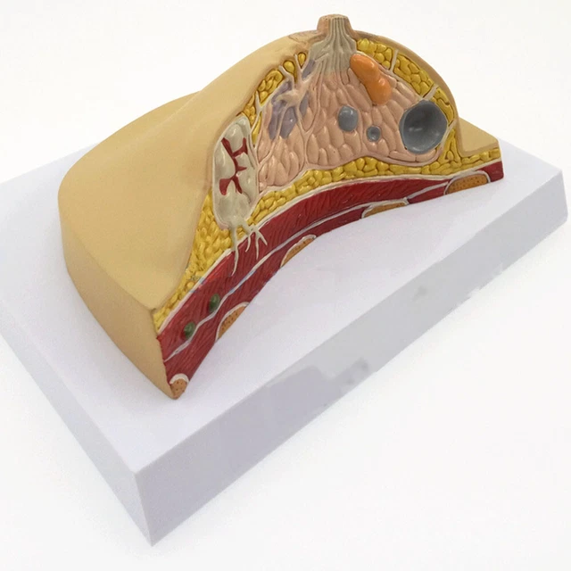 HUMAN PATHOLOGICAL BREAST Lesion Anatomical Model Medical Disease