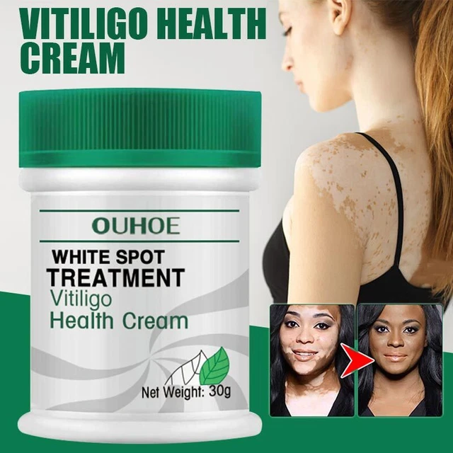Crema de manchas blancas pigmento antibacteriano tratamiento del vitiligo alivio de la leucoplasia.