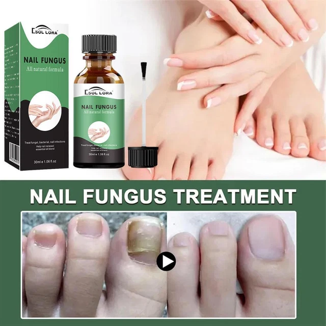 Nail Fungus Treatment, Extra Strong and Maximum Strength Solution, Saf –  pulchraheals