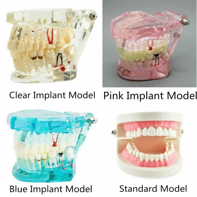 Dental Implant Teeth Model Disease Study Teaching Restoration Bridge Tooth Analy