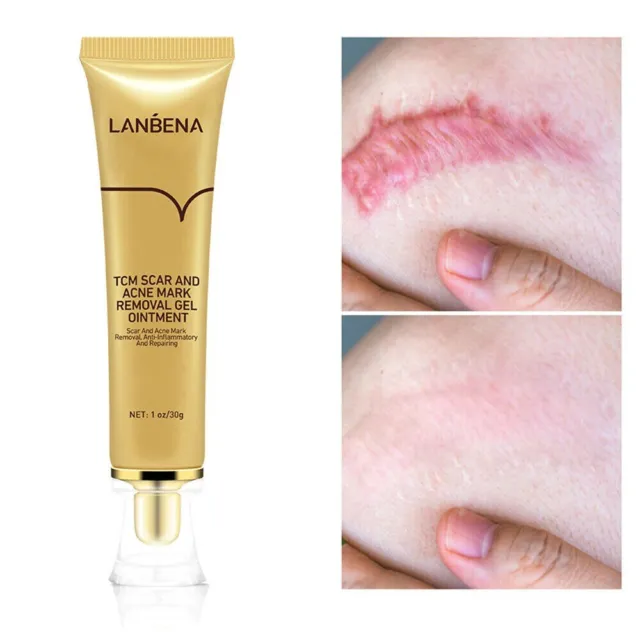 LanBeNa Narben-und Akne-Mark-Entfernung Salbe Hautpflege gel