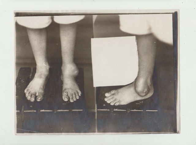 Vintage Medical Oddity Disease Accident Diformity Photo Freak Strange Circus 02