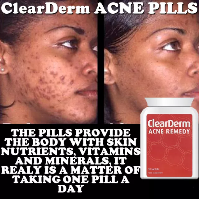 Clearderm Acne Pill Tablet Great Healthy Skin Spot Free Glowing Complexion