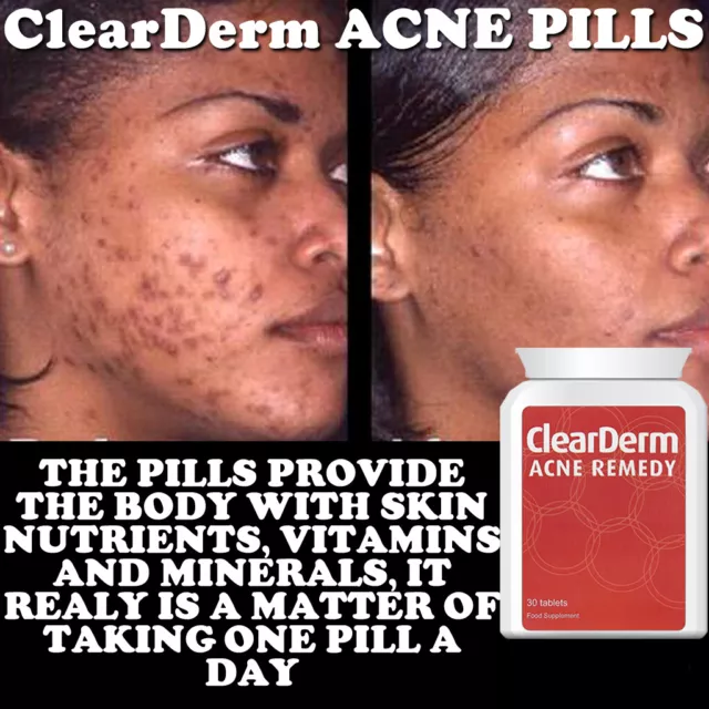 Clearderm Acne Pill Tablet Stop Pimples Spots Max Strength