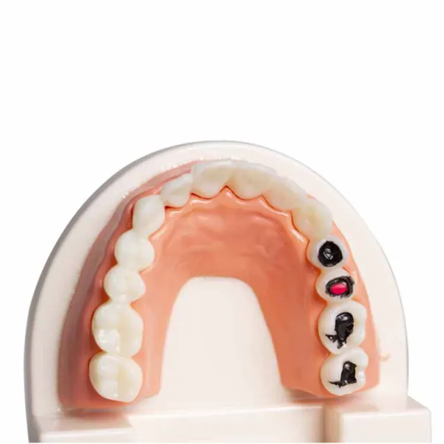 Dental Teeth Model Study Cavities Mode Model Standard Dentist Decay Model F1