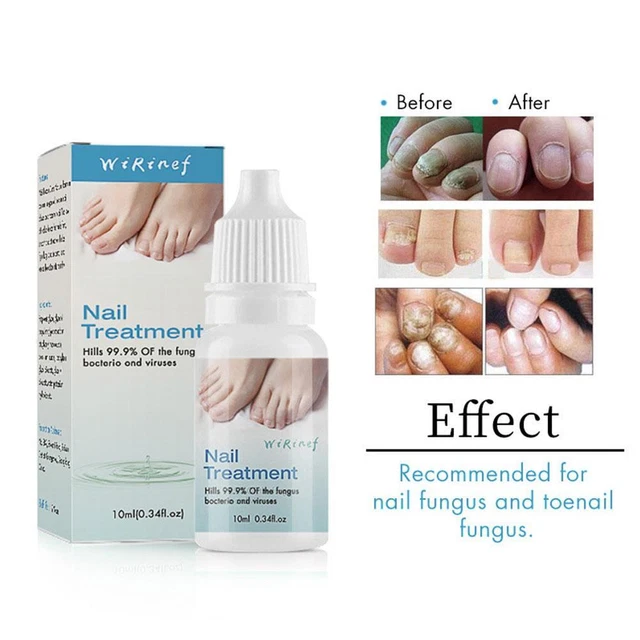 Tratamiento de hongos esencia reparación pie dedo del pie eliminación de hongos infección 7W3Q gel Q0V1