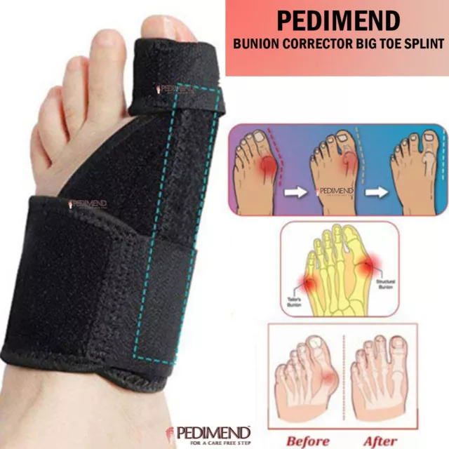 PEDIMEND Orthopädischer Fuß Hallux Valgus Korrektur Zehenschiene Ballen Schmerzlinse