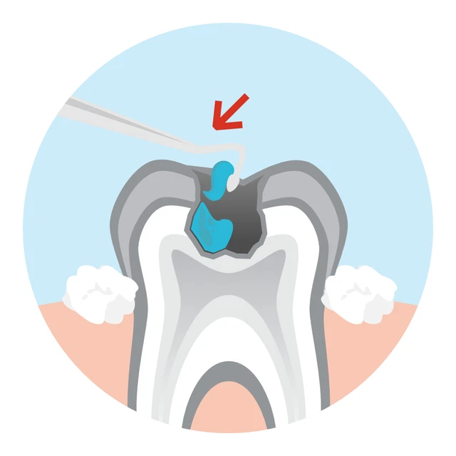Gel dissolvant de caries de matériel dentaire 1Pc pour le traitement de...