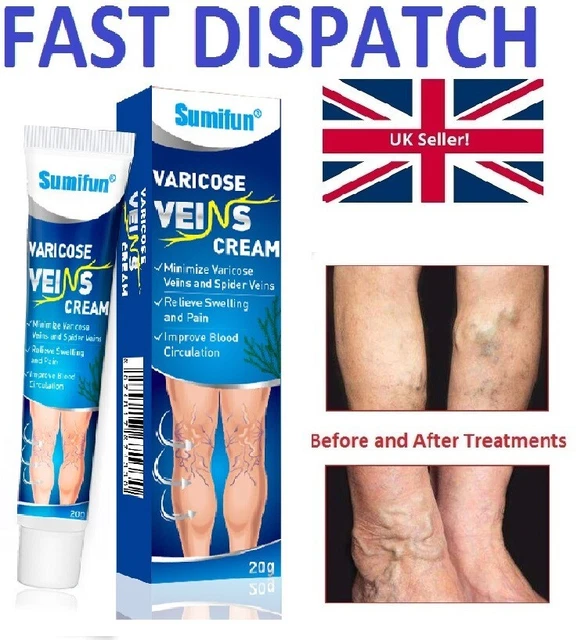VARICOSE VEINS VASCULITIS Legs Treatment Cream Gel Phlebitis Itchy