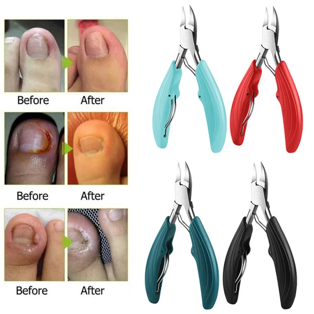 ONGLE COUPEONGLES INCARNÉ Pince Paronychia Outil Cuticule Olécrânienne — free download