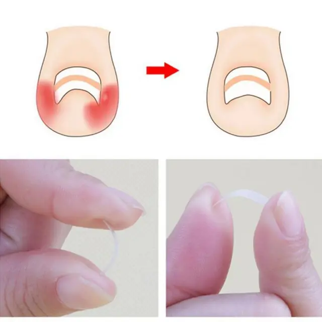 Clips de redressement des ongles incarnés en plastique, autocollants de
