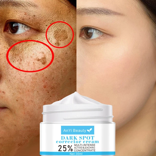 30 ml forte rimozione melasma whitening cream lentiggini speckle spot melanina ~