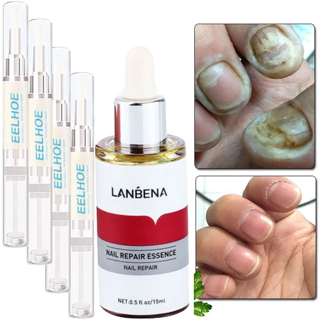 TOE NAIL FUNGUS Treatmen Killer Anti Fungal Infection Treat Toe Finger
