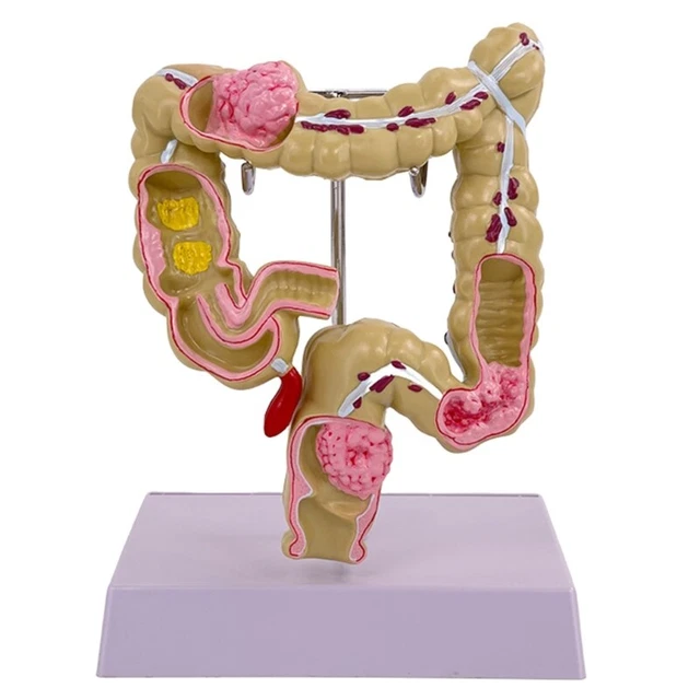 HUMAN PATHOLOGIES OF Large Intestine Model Medicals Teaching Tool for ...