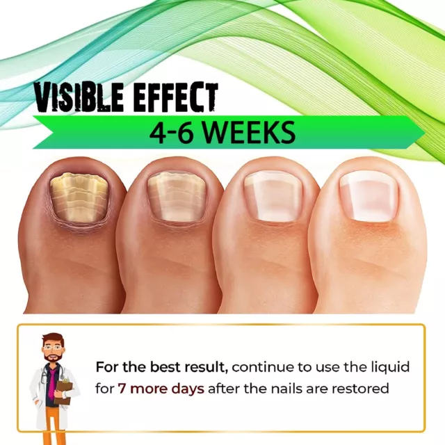 Anti Fungal Nail Treatment Severe Treatment for Toenails Extra Strong Fast Actin 2