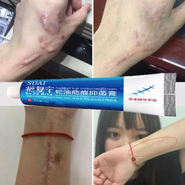 Scar Removal Cream Repairing Burn Scratch Pimples Scars R4O8 For All Skin T9R1