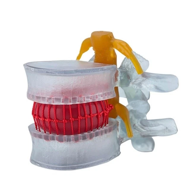 Disc Model Back LUMBAR DISC HERNIATION Model Movable Lumbar Spine Model Show ...