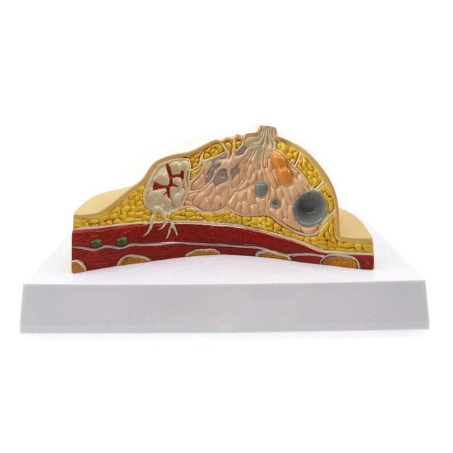 HUMAN PATHOLOGICAL BREAST Lesion Anatomical Model Medical Disease