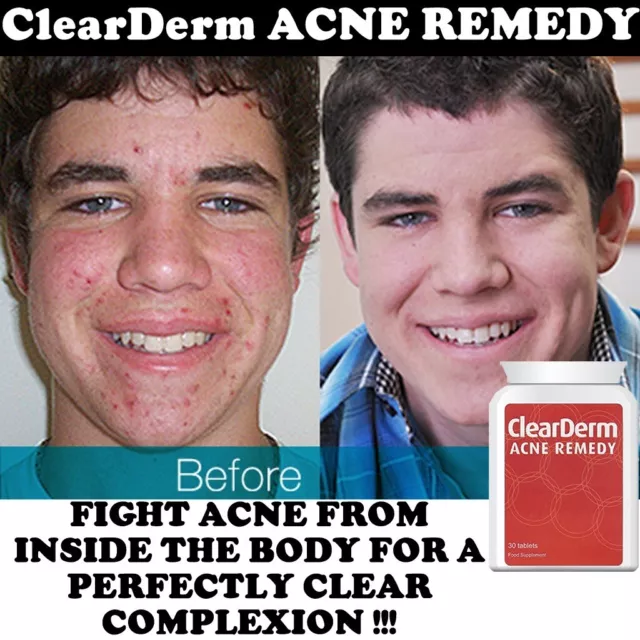 CLEARDERM ACNE PILLS TABLET - To be taken daily to target acne