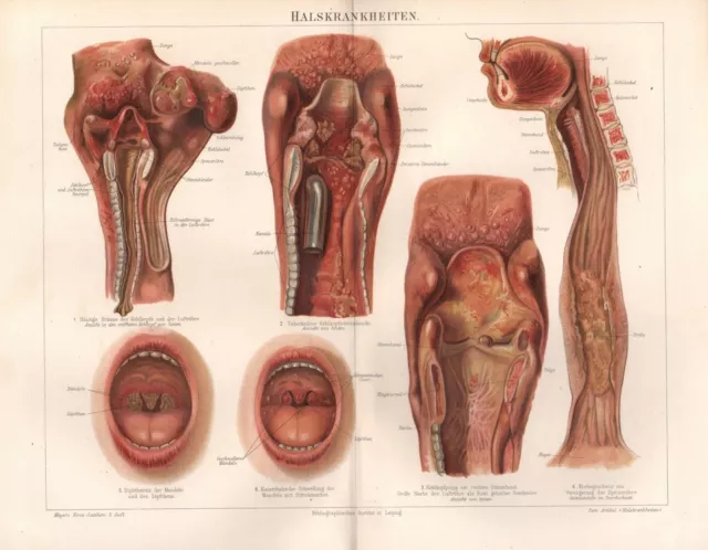 Halskrankheiten Diphtherie  Kehlkopfpolyp  Medizin Mensch Lithographie 1895