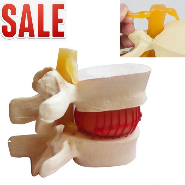 11.5 MEDICAL SPINE Lumbar Disc Herniation Model Demonstration Teach