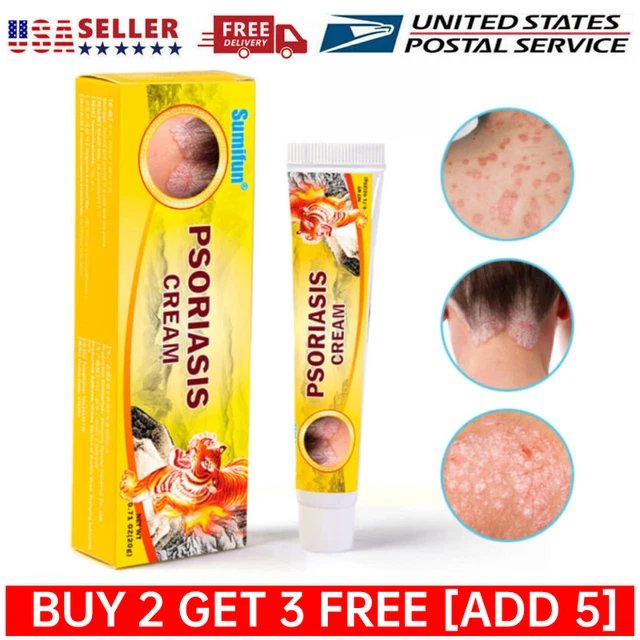 PSORIASIS CREAM ECZEMA Ointment Scalp Psoriasis Hand Foot Itching