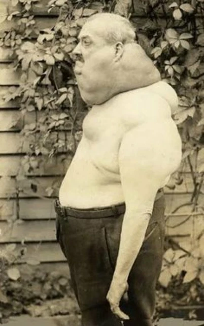Antique Medical Goiter Photo 10 Oddleys Strange & Bizarre 2