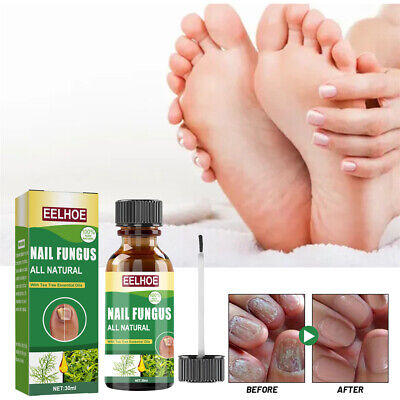 Tratamiento de uñas líquido hongos en las uñas de los pies atletas pie hongos uñas 30 ml