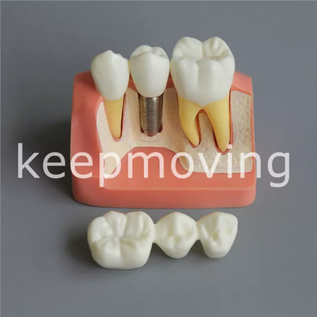 Dental Implant Analysis Crown Bridge Demonstration Teeth Tooth Model Typodont