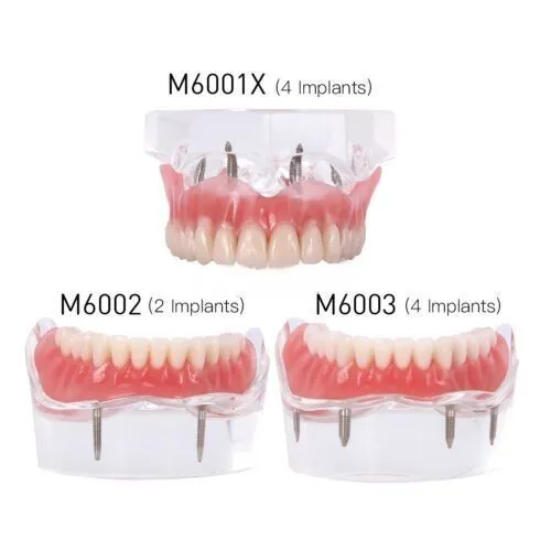 Dental Implant Teeth Model Demo Overdenture Restoration with 2/4 Implants U/L