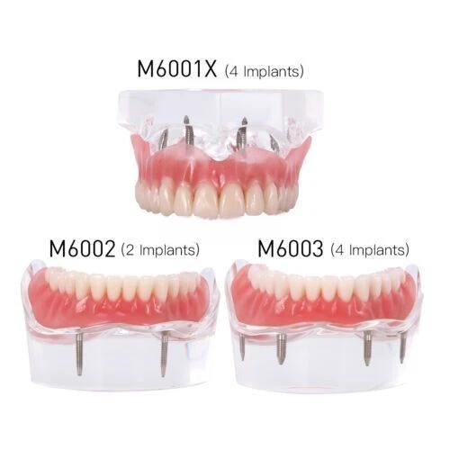 Dental Implant Teeth Model Demo Overdenture Restoration with 2/4 Implants U/L