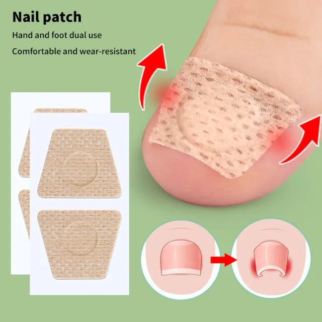 5Pairs Nail Care Patch Ingrown Toenail Correction Patch Foot Care Tool  F2