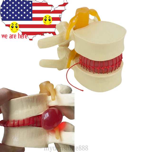 US SALE Medical Lumbar Spine Model Disc Herniation demonstration teach