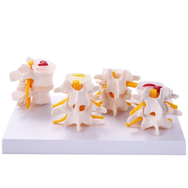 AnatomíA Esqueleto Espina 4 Etapas de Vertebral Lumbar Suministros de EnseñY4