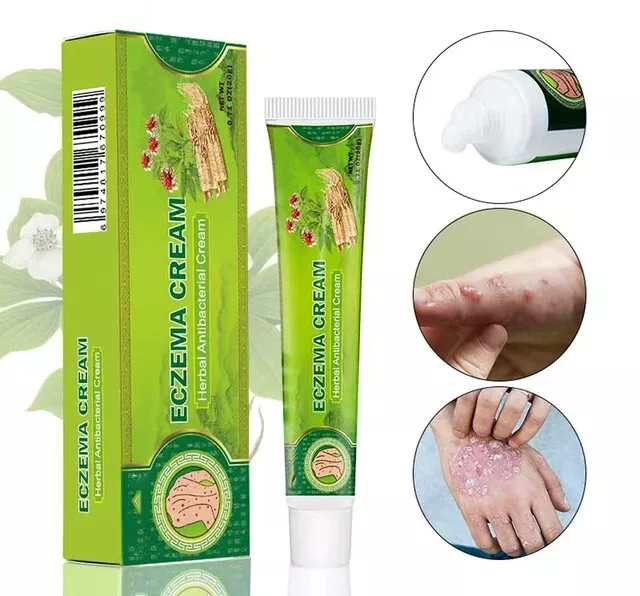 Eczema Dermatitis Psoriasis Skin Cream Ointment Treatment Anti-itching Salve UK