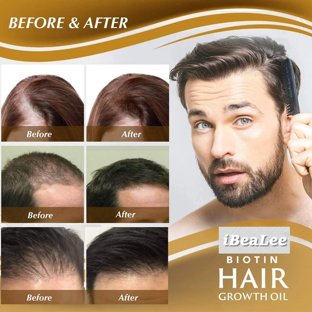 Calvicie reparación cabello loción pérdida de cabello aceite cuidado del cabello