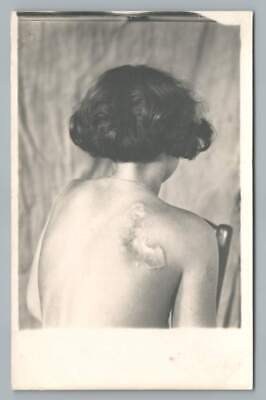 Petite French Woman w Giant Back Scar RPPC Interesting Antique Medical Photo 20s