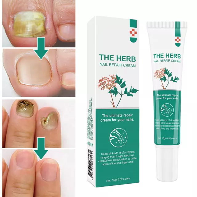 Nail Fungus Fungal Removal Cream Treatment Care Onychomycosis Infection Toenails 2